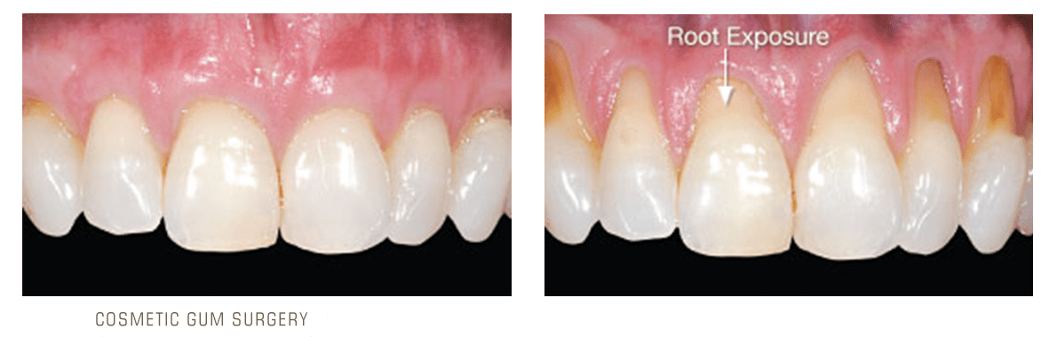 عمل جراحی زیبایی پیوند لثه