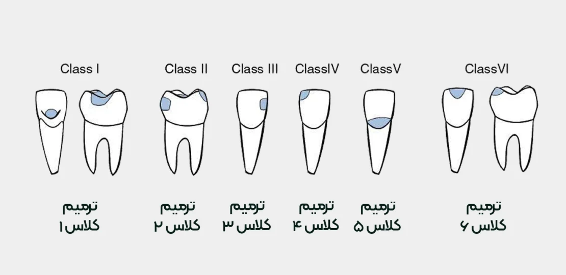 کلاس های مختلف ترمیم و پر کردن دندان