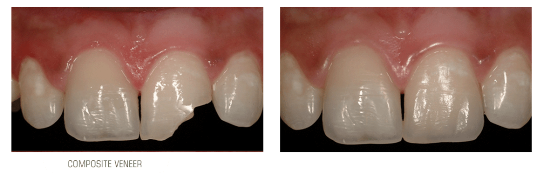 عکس ترمیم دندان شکسته با کامپوزیت دندان