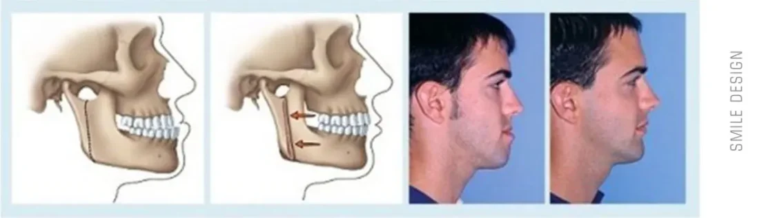 تاثیر اصلاح طر لبخند بر زیبایی صورت