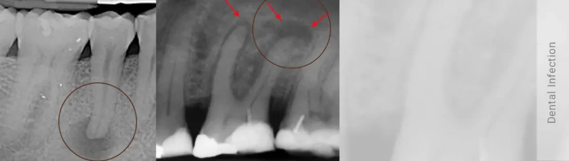 عکس عفونت ریشه دندان شدید مربوط به دندان آسیاب