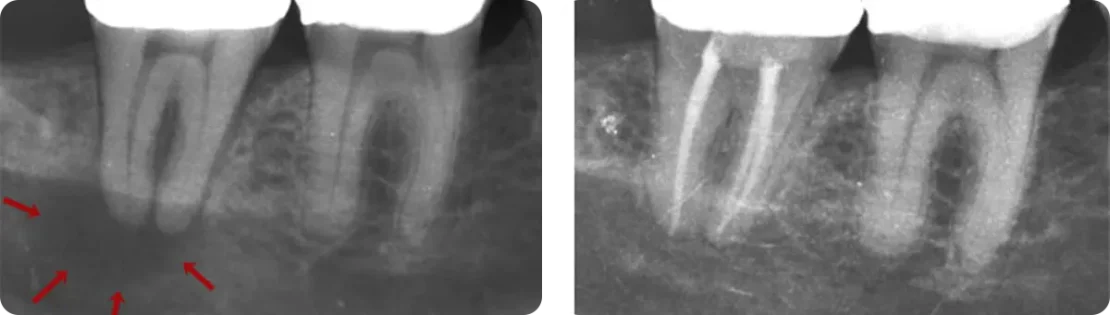 عکس قبل و بعد از درمان عفونت ریشه دندان