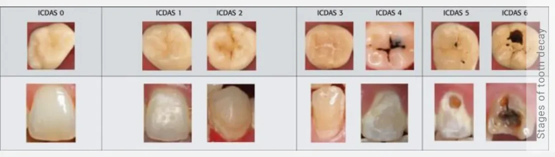 عکس مراحل مختلف آسیب دندانی