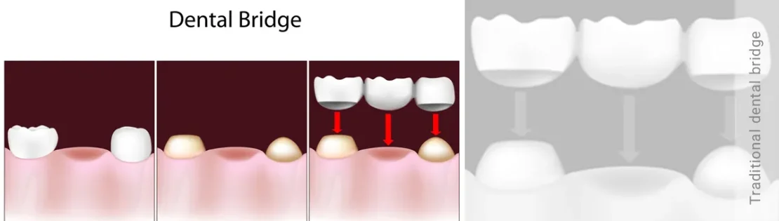 عکس بریج دندان سنتی