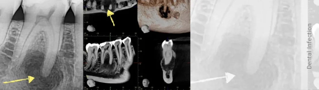 عکس عفونت ریشه دندان که نیاز به کشیدن دندان دارد