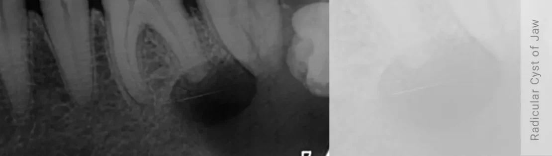 کیست استخوان فک پایین از نوع رادیکولار